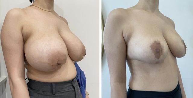Breast Augmentation result at Dr. Dana K. Khuthaila in New York, NY