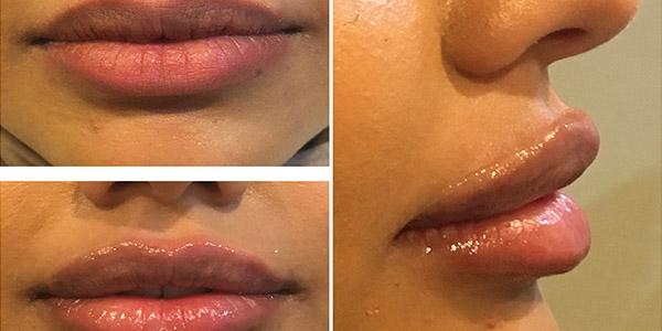 Juvederm result at Dr. Dana K. Khuthaila in New York, NY