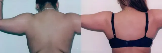 Arm Lift result at Boris M. Ackerman, MD in Newport Beach, CA