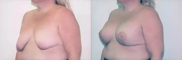 Breast Lift result at Boris M. Ackerman, MD in Newport Beach, CA