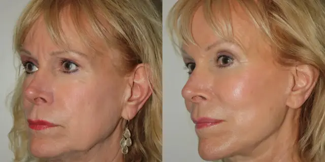 Brow Lift result at Boris M. Ackerman, MD in Newport Beach, CA