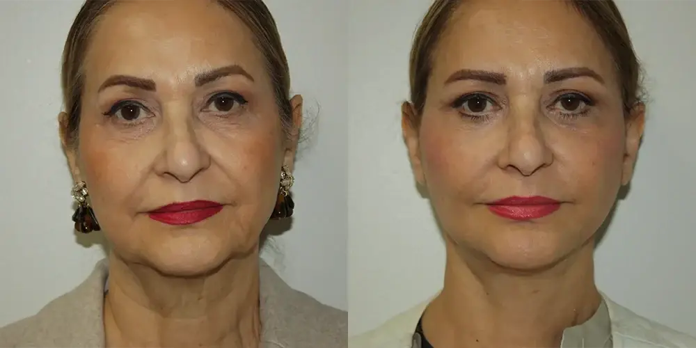 Boris M. Ackerman, MD facelift result — Newport Beach, CA