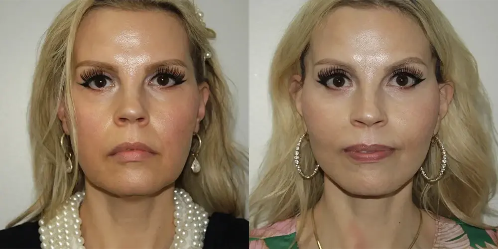 Boris M. Ackerman, MD facelift result — Newport Beach, CA