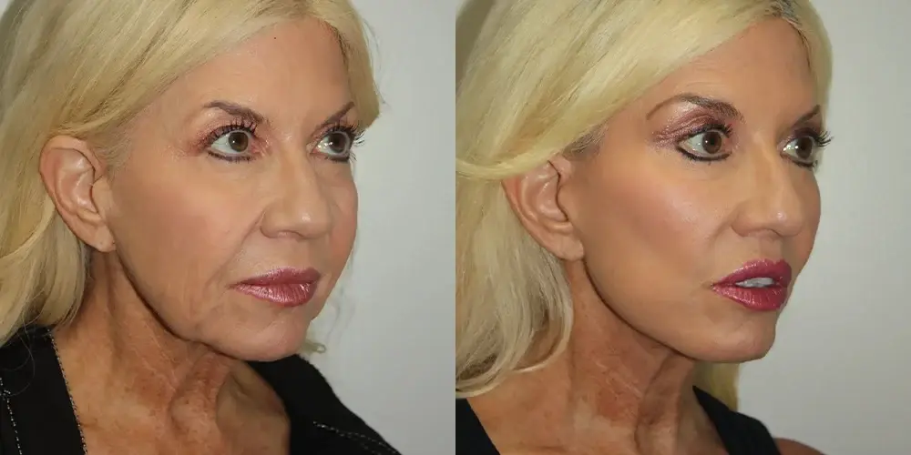 Boris M. Ackerman, MD facelift result — Newport Beach, CA