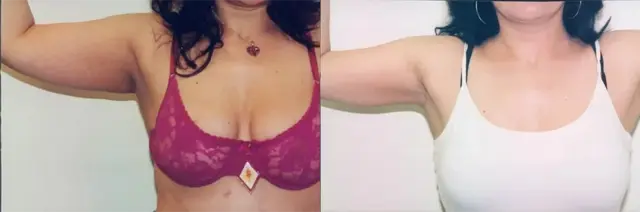 Arm Lift result at Boris M. Ackerman, MD in Newport Beach, CA