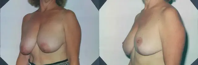 Breast Reduction result at Boris M. Ackerman, MD in Newport Beach, CA