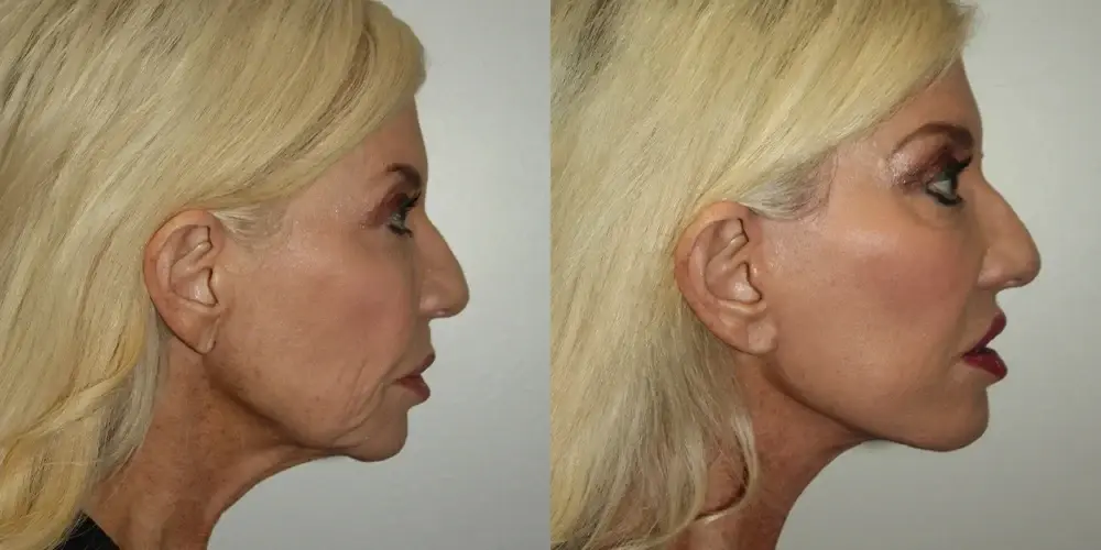 Boris M. Ackerman, MD facelift result — Newport Beach, CA