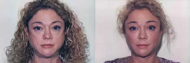 Blepharoplasty result at Boris M. Ackerman, MD in Newport Beach, CA