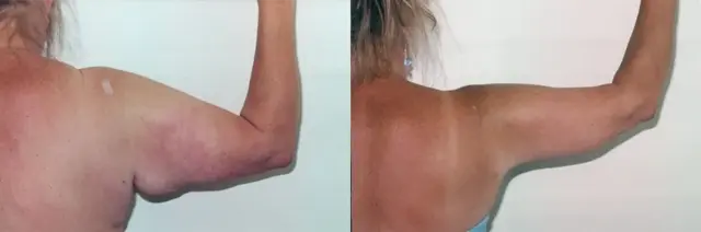 Arm Lift result at Boris M. Ackerman, MD in Newport Beach, CA