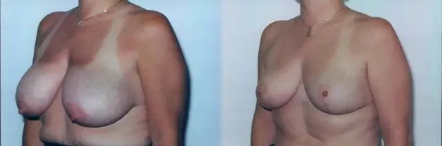 Breast Reduction result at Boris M. Ackerman, MD in Newport Beach, CA