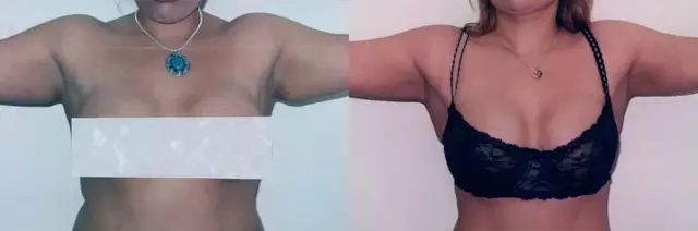 Arm Lift result at Boris M. Ackerman, MD in Newport Beach, CA