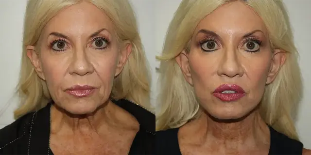 Facelift result at Boris M. Ackerman, MD in Newport Beach, CA