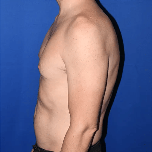 PA Plastic Surgery Center - Dr Paul Warner Papillion after — Brentwood, TN