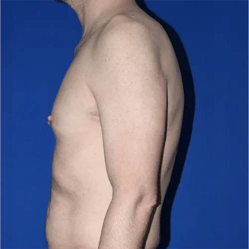 Gynecomastia Surgery before at PA Plastic Surgery Center - Dr Paul Warner Papillion in Brentwood, TN