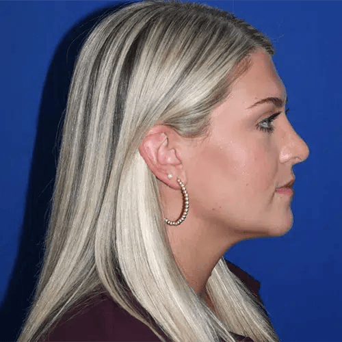 Rhinoplasty after at PA Plastic Surgery Center - Dr Paul Warner Papillion in Brentwood, TN