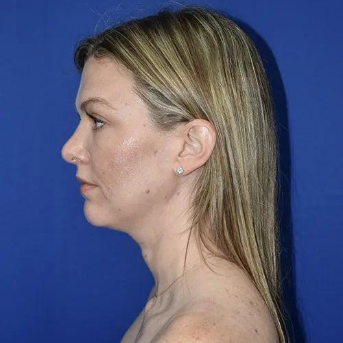 Rhinoplasty after at PA Plastic Surgery Center - Dr Paul Warner Papillion in Brentwood, TN