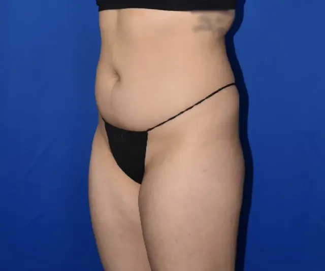 Liposuction before at PA Plastic Surgery Center - Dr Paul Warner Papillion in Brentwood, TN