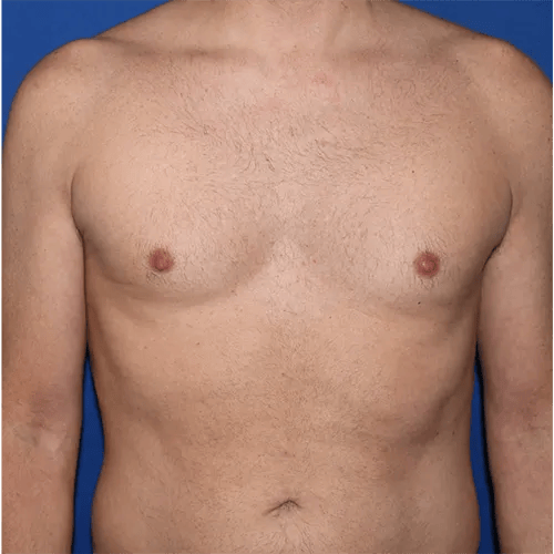 PA Plastic Surgery Center - Dr Paul Warner Papillion after — Brentwood, TN