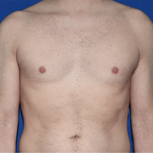 Gynecomastia Surgery before at PA Plastic Surgery Center - Dr Paul Warner Papillion in Brentwood, TN