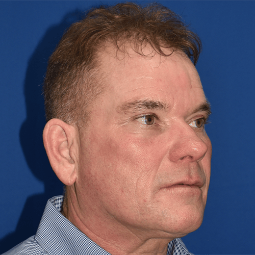 Morpheus8 after at PA Plastic Surgery Center - Dr Paul Warner Papillion in Brentwood, TN