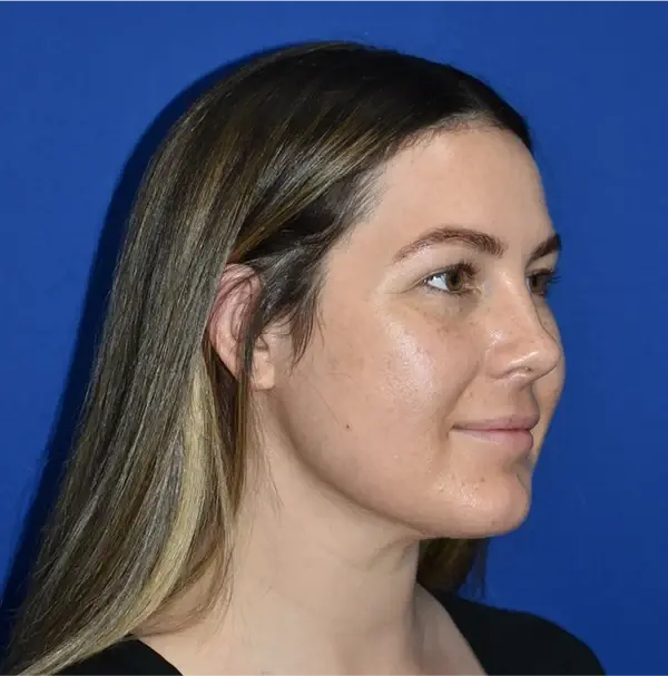 PA Plastic Surgery Center - Dr Paul Warner Papillion neck liposuction after — Brentwood, TN