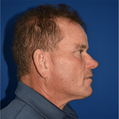 Morpheus8 before at PA Plastic Surgery Center - Dr Paul Warner Papillion in Brentwood, TN