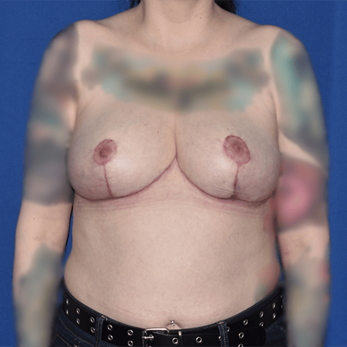Breast Reduction after at PA Plastic Surgery Center - Dr Paul Warner Papillion in Brentwood, TN