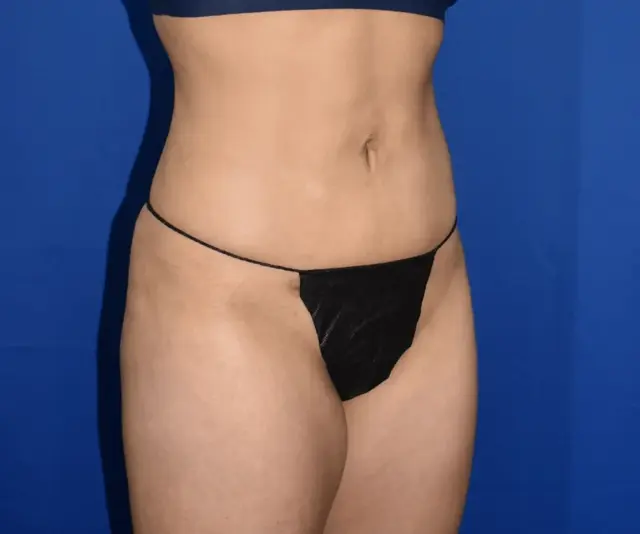 Liposuction after at PA Plastic Surgery Center - Dr Paul Warner Papillion in Brentwood, TN