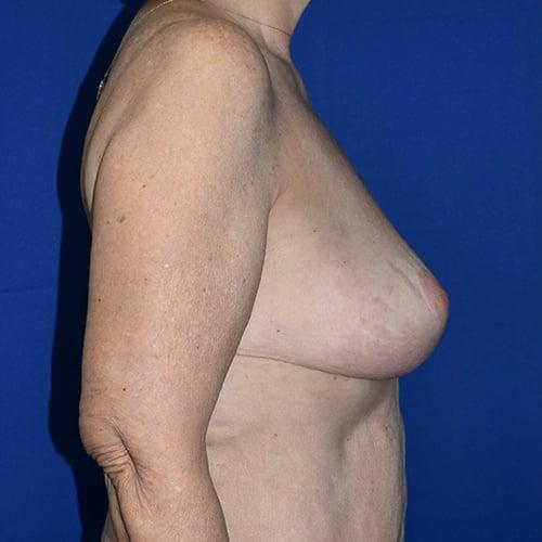 Breast Augmentation after at PA Plastic Surgery Center - Dr Paul Warner Papillion in Brentwood, TN