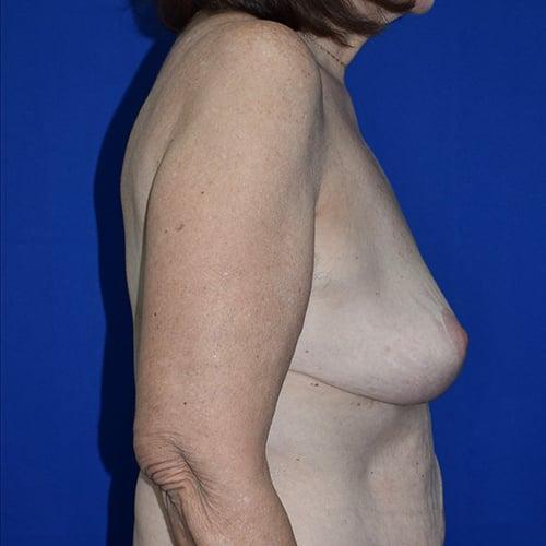 Breast Augmentation before at PA Plastic Surgery Center - Dr Paul Warner Papillion in Brentwood, TN