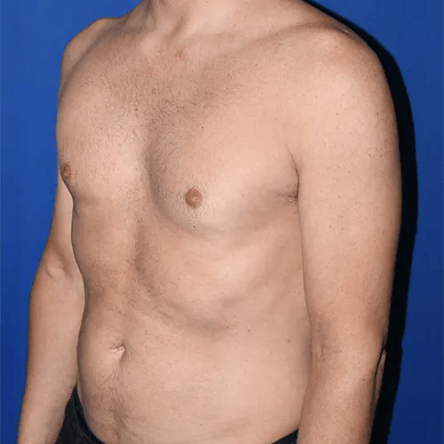 PA Plastic Surgery Center - Dr Paul Warner Papillion after — Brentwood, TN