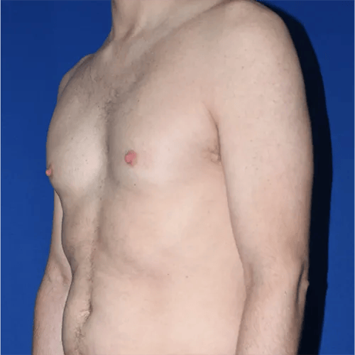 Gynecomastia Surgery before at PA Plastic Surgery Center - Dr Paul Warner Papillion in Brentwood, TN