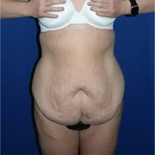 Tummy Tuck before at PA Plastic Surgery Center - Dr Paul Warner Papillion in Brentwood, TN