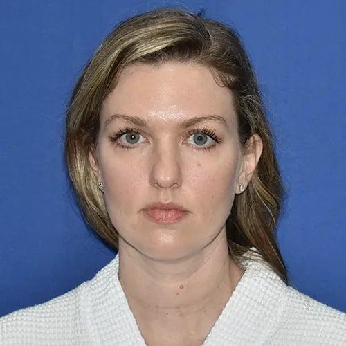 Rhinoplasty before at PA Plastic Surgery Center - Dr Paul Warner Papillion in Brentwood, TN
