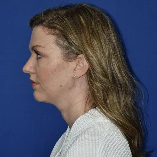 Rhinoplasty before at PA Plastic Surgery Center - Dr Paul Warner Papillion in Brentwood, TN