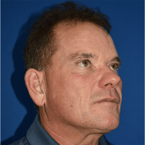 Morpheus8 before at PA Plastic Surgery Center - Dr Paul Warner Papillion in Brentwood, TN