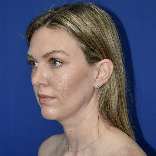 Rhinoplasty after at PA Plastic Surgery Center - Dr Paul Warner Papillion in Brentwood, TN