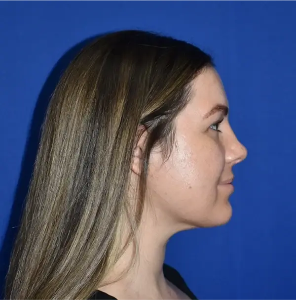 PA Plastic Surgery Center - Dr Paul Warner Papillion neck liposuction after — Brentwood, TN