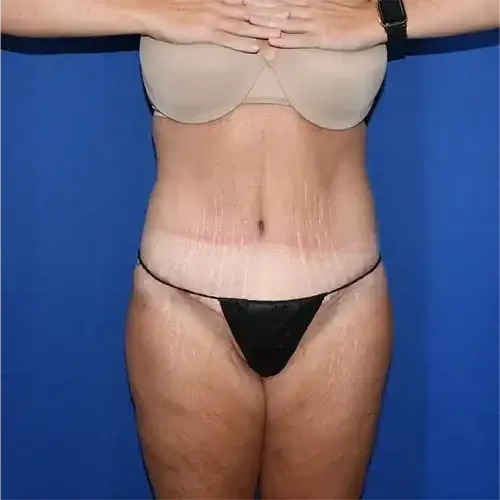 Tummy Tuck after at PA Plastic Surgery Center - Dr Paul Warner Papillion in Brentwood, TN