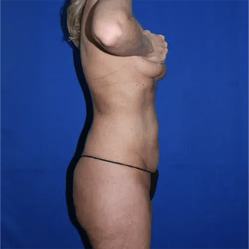 Tummy Tuck before at PA Plastic Surgery Center - Dr Paul Warner Papillion in Brentwood, TN