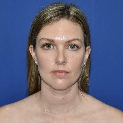 Rhinoplasty after at PA Plastic Surgery Center - Dr Paul Warner Papillion in Brentwood, TN