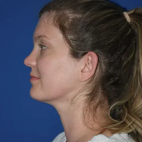 PA Plastic Surgery Center - Dr Paul Warner Papillion neck liposuction after — Brentwood, TN