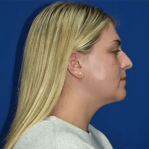 Rhinoplasty before at PA Plastic Surgery Center - Dr Paul Warner Papillion in Brentwood, TN