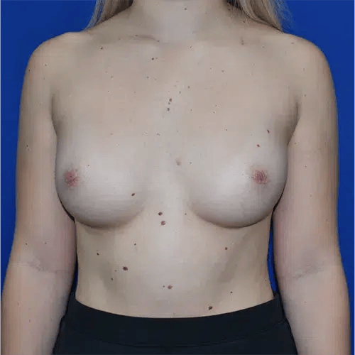 Breast Augmentation before at PA Plastic Surgery Center - Dr Paul Warner Papillion in Brentwood, TN