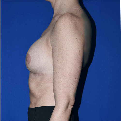 PA Plastic Surgery Center - Dr Paul Warner Papillion breast augmentation after — Brentwood, TN