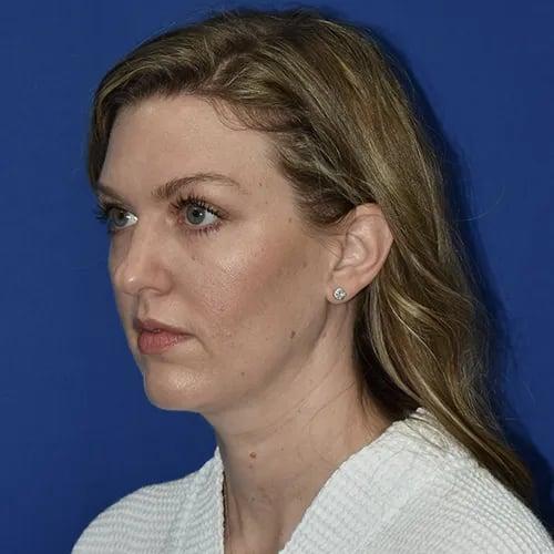 Rhinoplasty before at PA Plastic Surgery Center - Dr Paul Warner Papillion in Brentwood, TN