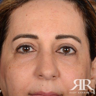Dr. Rady Rahban blepharoplasty after — Beverly Hills, CA