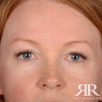 Dr. Rady Rahban blepharoplasty after — Beverly Hills, CA
