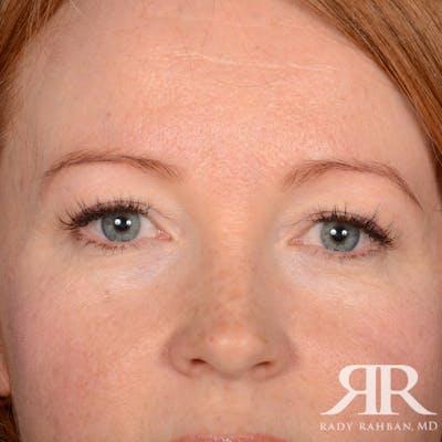 Blepharoplasty before at Dr. Rady Rahban in Beverly Hills, CA