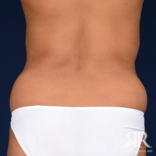 Liposuction before at Dr. Rady Rahban in Beverly Hills, CA